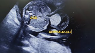 Omphalocele in ultrasound Usg [upl. by Tortosa988]