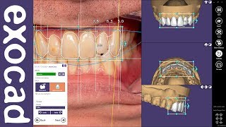 exocad Quick Guide Get the most out of your Smile Creator Module [upl. by Leigh]