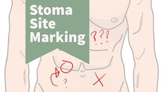 The Importance of Stoma Site Marking [upl. by Bessie]