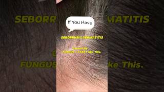 Seborrheic Dermatitis How to treat your Scalp itchyscalp shorts dandruff seborrheicdermatitis [upl. by Ahscrop]