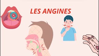 Angines  Types Symptômes et Traitements – Tout ce quil Faut Savoir [upl. by Wailoo747]