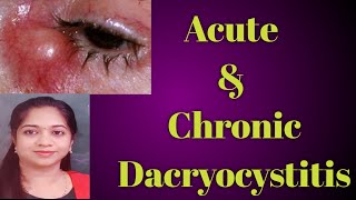 Dacryocystitis  Acute dacryocystitis Chronic Dacryocystitis Stages of Dcryocystitis Mucocele [upl. by Antonina]