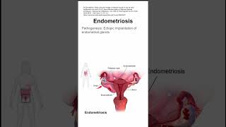 Endometriosis [upl. by Htabmas]