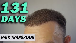 FUE Hair Transplant 131 DAYS post op Istanbul Turkey GROWTH STAGE [upl. by Hermie]