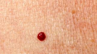 REMOVE CHERRY ANGIOMA AT HOME FOR FREE EASY MEDICAL LIFE HACK [upl. by Luckin]