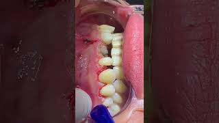 Simple Gingivectomy using diathermy surtron 50 watt dentist brace orthodontics dental teeth [upl. by Lai]