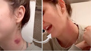 How To Get Rid Of A Hickey In 2 Minutes [upl. by Teeter88]