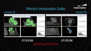 Faster segmentation in Mimics 19  Mimics Innovation Suite  Materialise Medical [upl. by Tuppeny323]