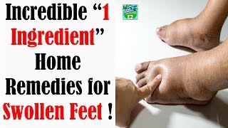 Incredible “1 Ingredient” Home Remedies for Swollen Feet [upl. by Alidia40]