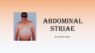 Abdominal striae  causes pathogenesis sign value [upl. by Dolly336]