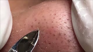 角栓 除去 blackheads removal 111 [upl. by Felecia]