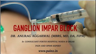 GANGLION IMPAR BLOCK [upl. by Glynas110]