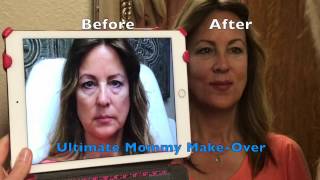 LIQUID FACELIFT  ULTIMATE Dermal Filler MAKEOVER [upl. by Cud]