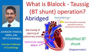 What is Blalock  Taussig BT shunt operation Abridged [upl. by Mirak]