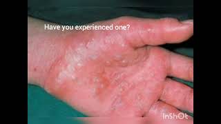 What is dyshidrotic eczema [upl. by Rockwell]