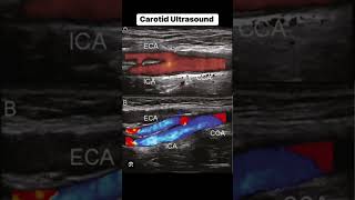 Carotid Ultrasound [upl. by Dikmen259]