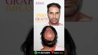 Incredible 3500 Advanced FUE Grafts Hair Transplant by Dr Suneet Soni at Medispa Hair Transplant [upl. by Leinadnhoj]