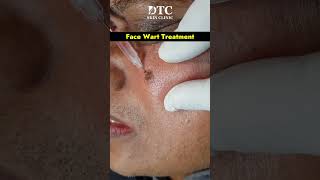 Removing Face Warts Safely and Effectively Treatment Options at DTC Skin Clinic [upl. by Joly]