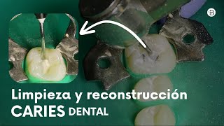 Limpieza y reconstrucción de CARIES dental PASO A PASO [upl. by Arihas766]