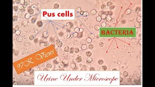 pus cells rbc bacteria in urine uti patient [upl. by Urd]