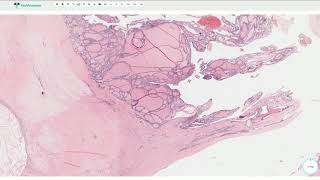 Multinodular Goiter  Thyroid Gland Histopathology [upl. by Fiore480]