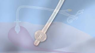 M270BR  Common Feeding Tubes Replacement Balloon Gastrostomy Tubes [upl. by Clementina]