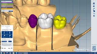 Designing with Amann Girrbach Ceramill Mind [upl. by Marentic40]