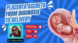 All About Placenta Accreta From Diagnosis to Delivery Doppler types healthytips DrSaimakhan [upl. by Kind655]