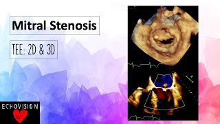 Mitral Stenosis [upl. by Stroud]