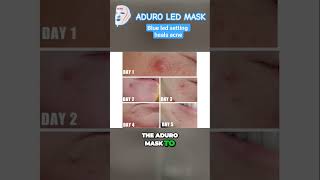 🔵 Clears stubborn cystic acne in record time with this ledlighttherapy aduro acne [upl. by Aislehc345]