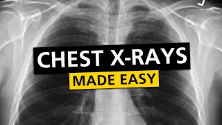 Chest X Rays CXR Made Easy  Learn in 10 Minutes [upl. by Ahsien98]