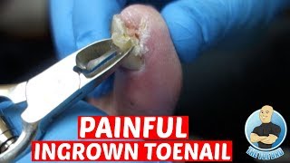 Pedicure Tutorial Ingrown Toenail Treatment At Home How to Recut Nail Groove to Eliminate Pain [upl. by Willcox]