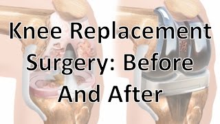 Knee Replacement Surgery Before And After [upl. by Sergeant]