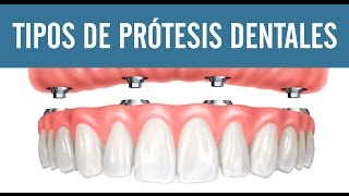 Tipos de prótesis dentales  Juan Salgado  Protesis Dentales [upl. by Dewhurst]