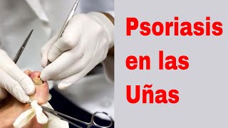 🖐🖐 Psoriasis de Uñas  Psoriasis en las Uñas 🖐🖐 [upl. by Nicki]