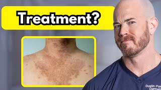 How to Treat Tinea Versicolor  Dr Dustin Portela [upl. by Greenman]