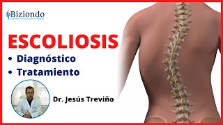 👨🏽‍⚕️ ¿Qué es la Escoliosis  Columna desviada ▶ Diagnóstico y tratamiento  BIZIONDO [upl. by Grantley177]