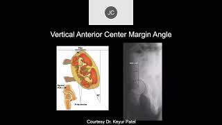 MRI of the Hip Part 1 – Hip AVN [upl. by Accebar]