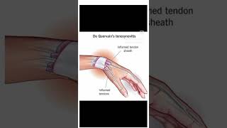 Treatment Of Dequervain Tenosynovitis ImMobile the area surrounded your thumb [upl. by Hoagland35]