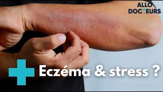 Eczéma  quelles solutions   Allo Docteurs [upl. by Anelaf379]