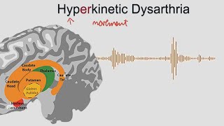 Hyperkinetic Dysarthria  samples and explanation [upl. by Sinnard]