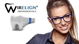 Wirelign® Orthodontics The Better Way To Your Best Smile [upl. by Jordans]