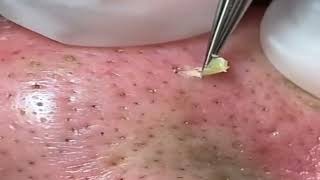 shorts Huge Blackheads Removal with a Tweezer 01 [upl. by Anayet933]