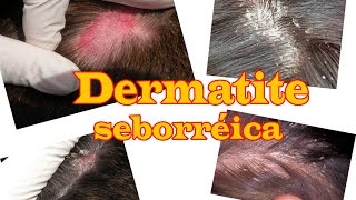 Caspa e dermatite seborreica como controlei [upl. by Pathe]