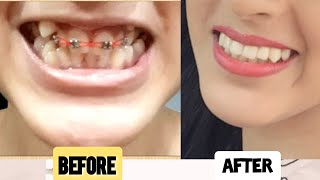 DentalTeeth transformation  Before and after braces removal  Braces timelapse [upl. by Allisurd]