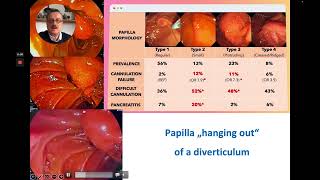 ERCP  Precut Sphincterotomy Using the Huibregtse Needle KnifeBiliary Catheter [upl. by Lledrac709]