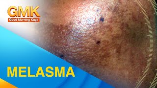 MELASMA Cause and Treatment Explained by Dermatologist [upl. by Anayet]