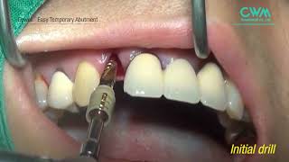 Easy Temporary Abutment [upl. by Enra]