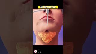 Chin Liposuction [upl. by Neeloc]