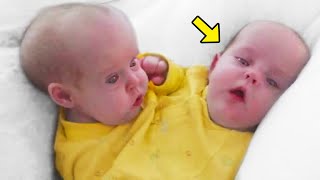 Remember These Conjoined Twins Separated 18 Years Ago This Is What Happened To Them [upl. by Matias]